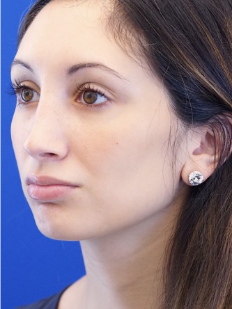 Nasal Profile Aesthetics — After