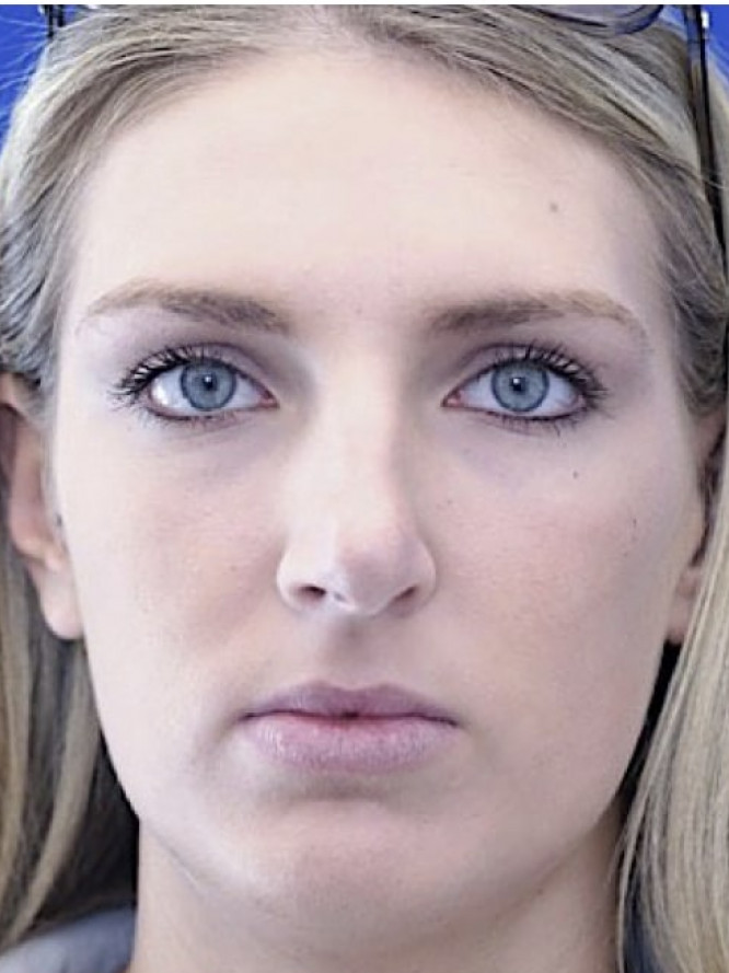 Tension Nose — Before