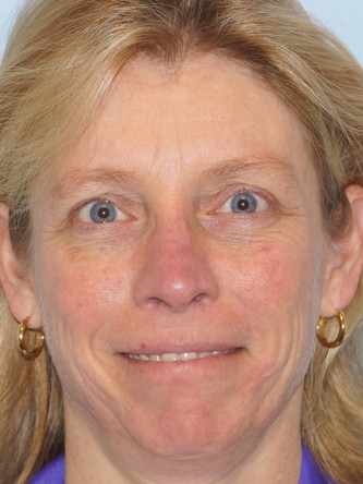 Upper Eyelid Droop1 (Ptosis)* — After