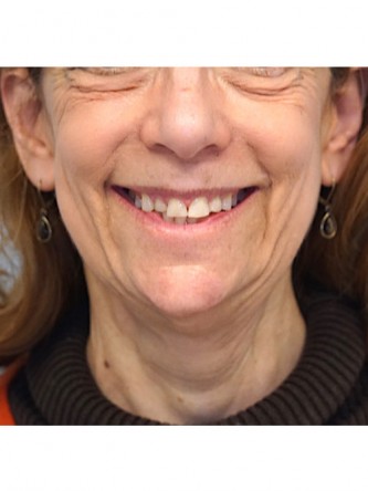 Full Face and Necklift, Upper and Lower Eyelid, Browlift* — Before
