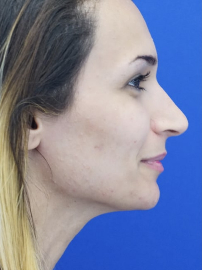 Nasal Deviation and Dainty Tip — Before