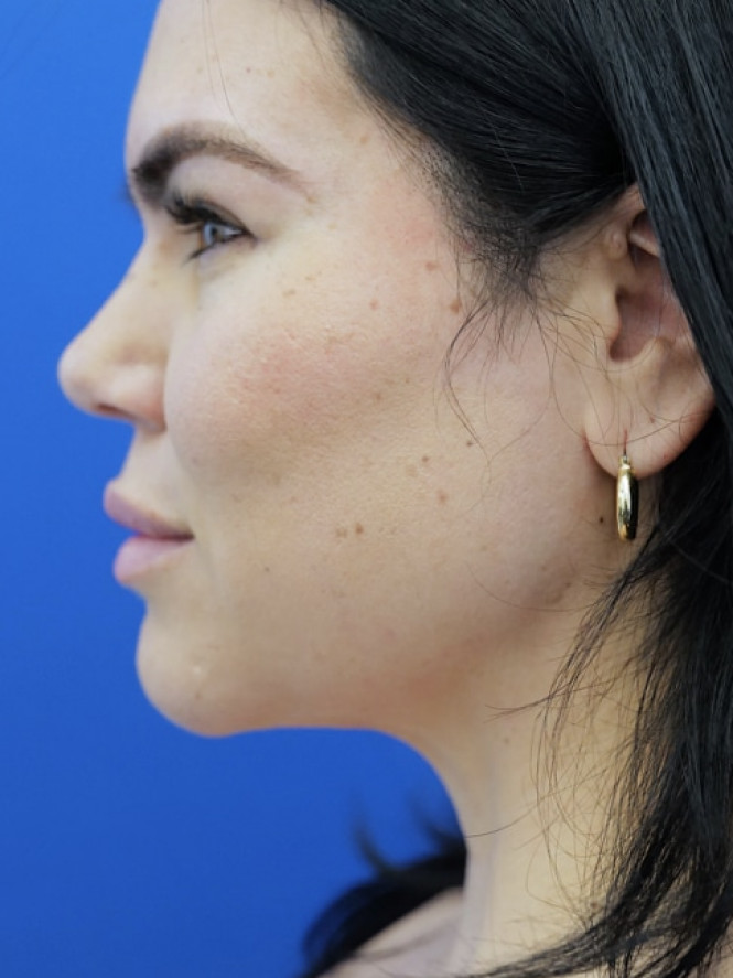 Jaw Line Etching — After