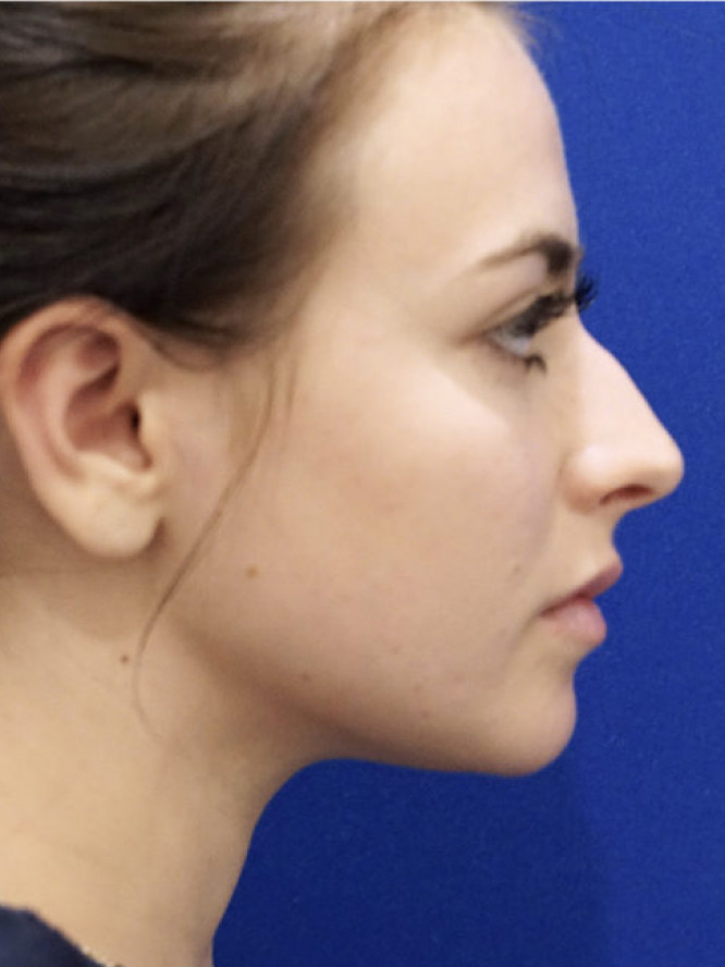Smooth Dorsal Contour — Before