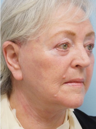 Aging Eyelid, Facelift, Necklift, Fractional CO2 Laser Resurfacing* — After