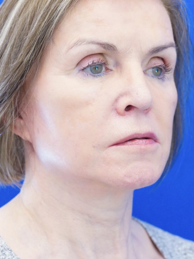 Deep Plane Lift and Fat Grafting — After
