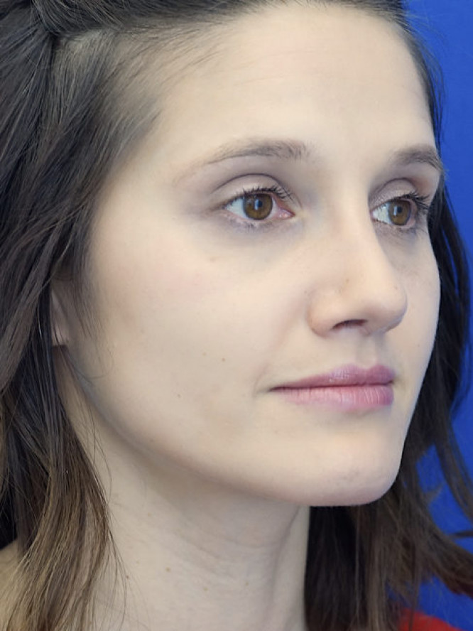 Nasal Profile Bliss — After