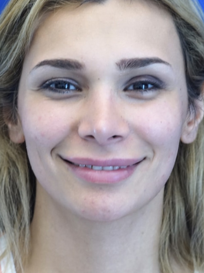 Nasal Deviation and Dainty Tip — After