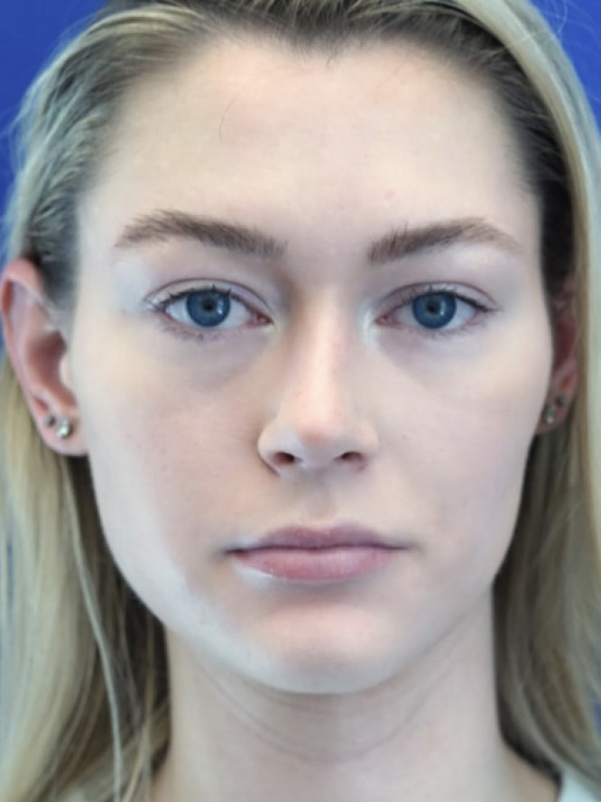 Nasal Profile Plasty — After