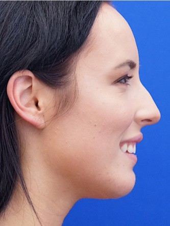 Chin Implant and Upper Lip Filler* — After