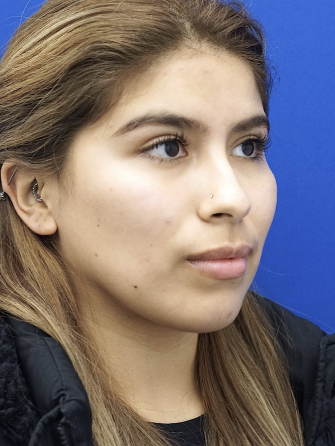Cheek Contouring — After