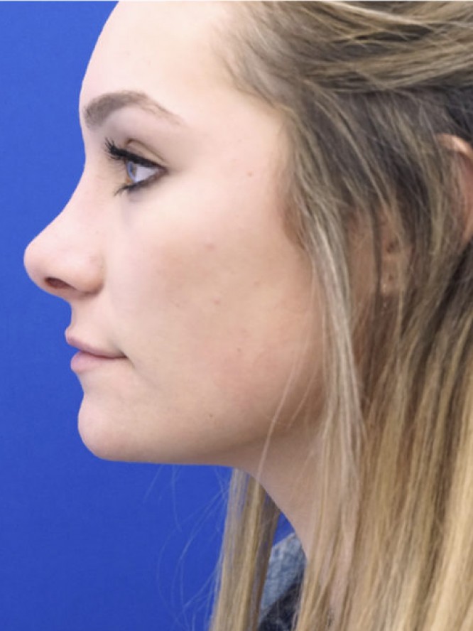 Endonasal Profile — After