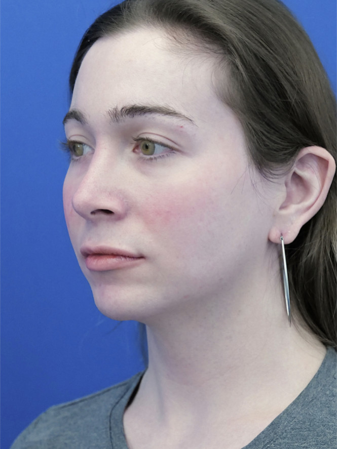 Soften Nasal Contour — After