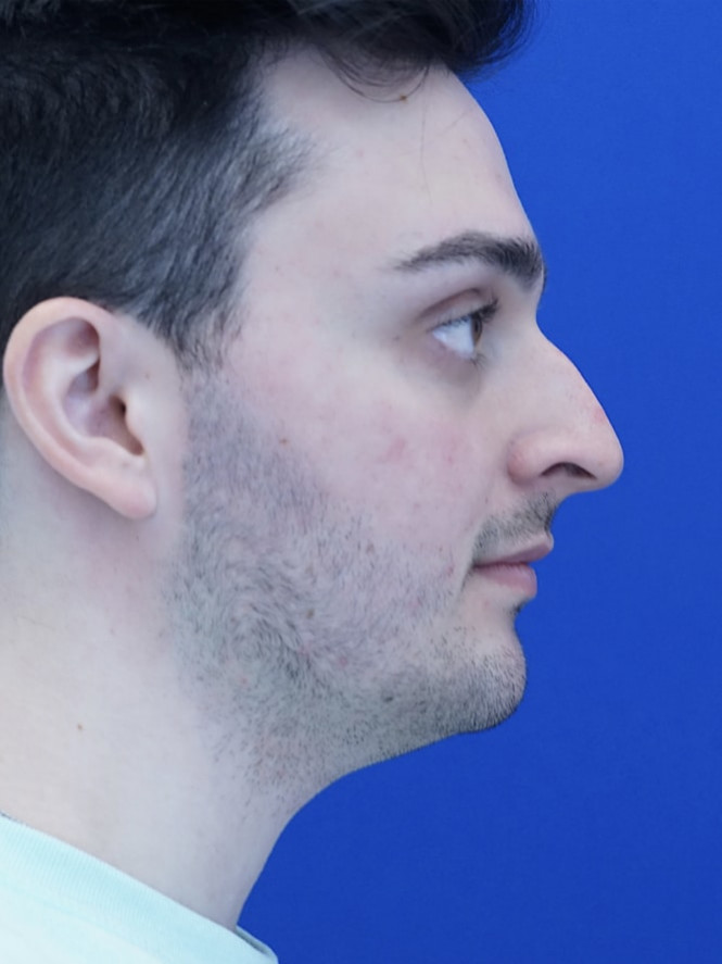 Profile Enhancement — Before
