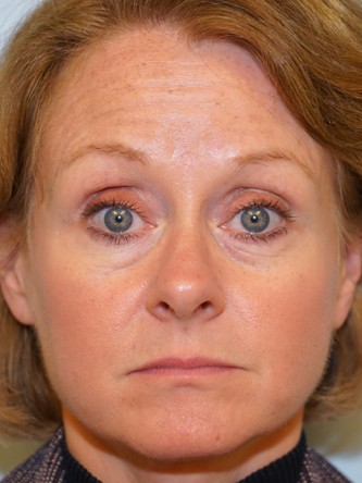 Lower Eyelid Excess Fat Pad1* — Before