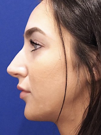 Nasal Hump Closed Rhinoplasty — Before