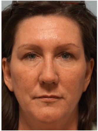Botox Browlift2* — After