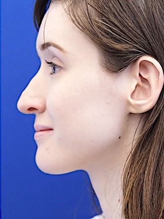 Nasal Profile Irregularity — Before