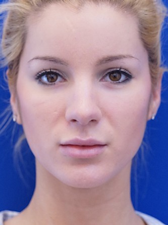 Restylane Silk Highlights Beautiful Lips* — After