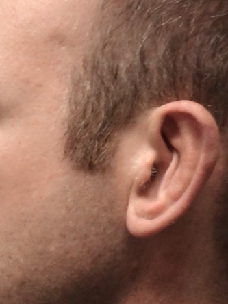 Protruding Ears – Moderate* — After