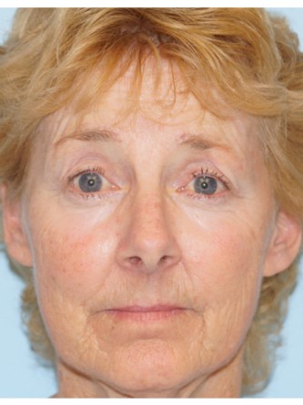 Upper Eyelid Droop2* — After