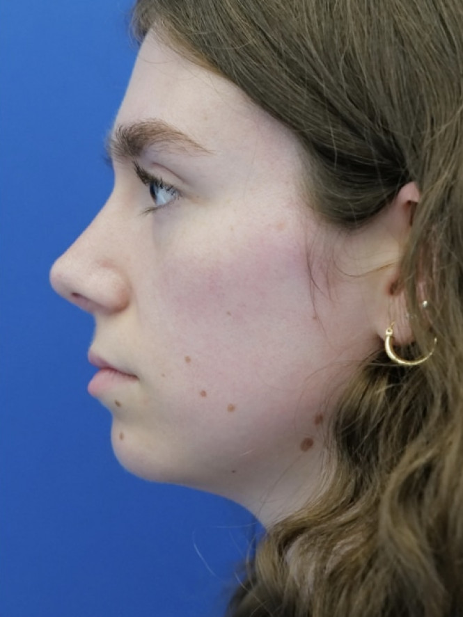 Preservation Rhinoplasty1 — After
