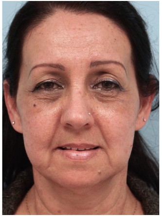 Aging Eyelid Rejuvenation, Facelift, Necklift 2* — Before