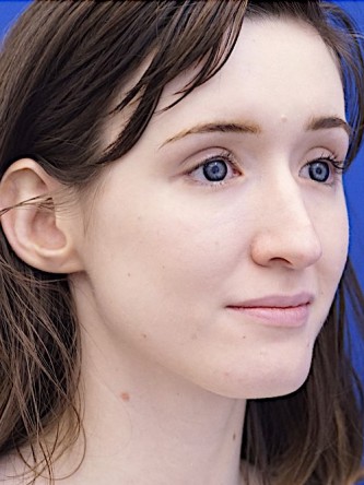 Nasal Profile Irregularity — Before