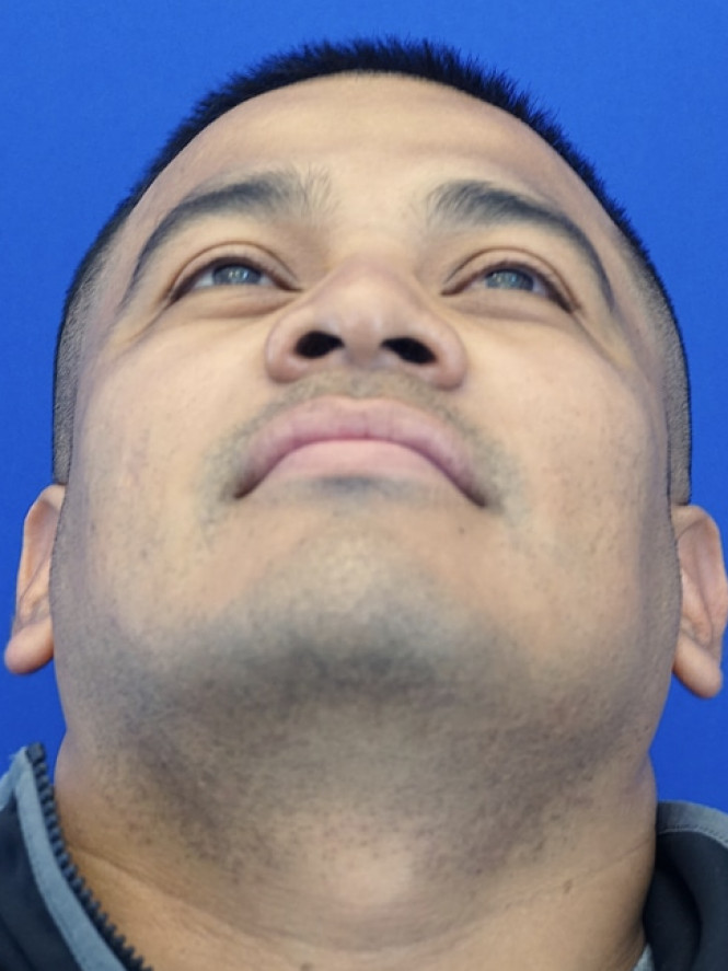Rhinoplasty Trifecta — Before