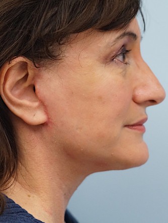 Mini Face and Neck Lift* — After