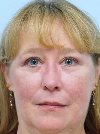 Upper and Lower Eyelid Blepharoplasty* — After