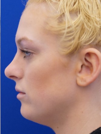 Restylane Silk Equalizes Lip Volume* — After