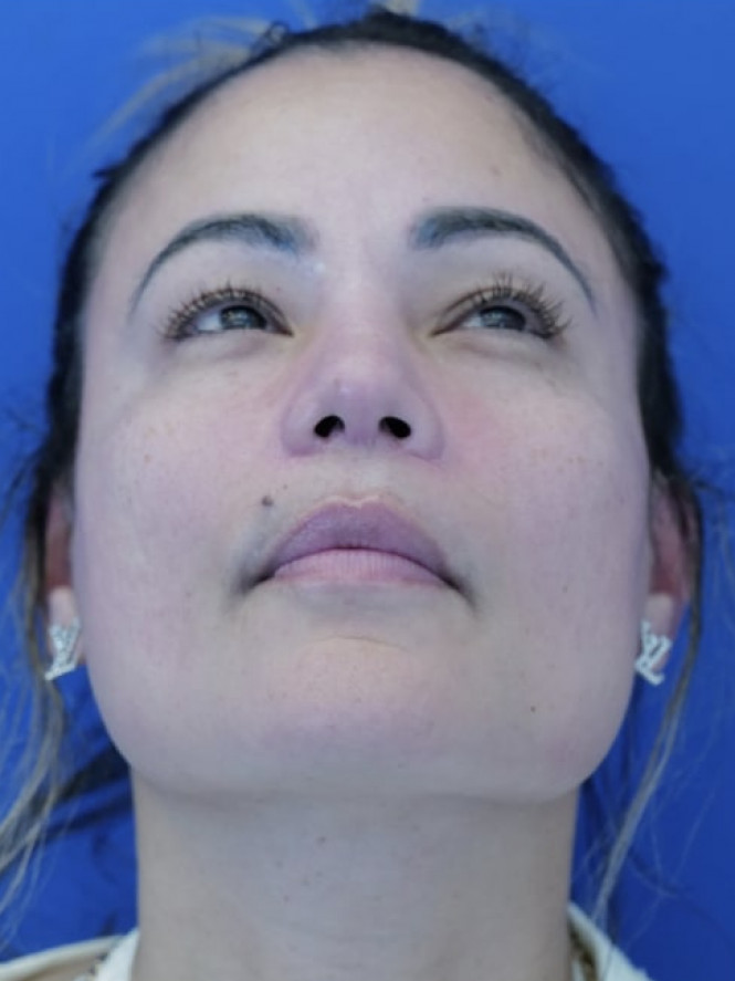 Dorsal Preservation and Narrow Base — After