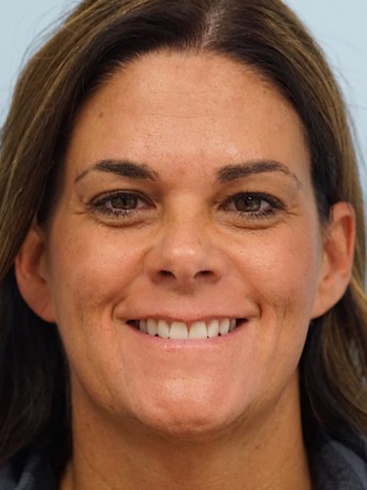 Glabellar Botox and Filler* — After