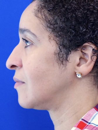 Ethnic Rhinoplasty* — Before