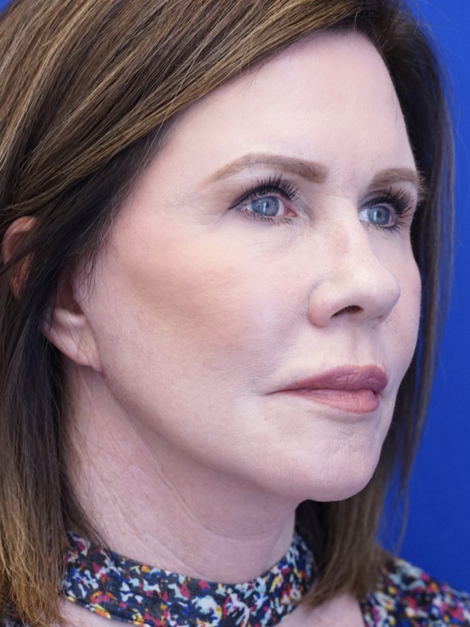 Secondary Lift and Facial Fat Grafting — After