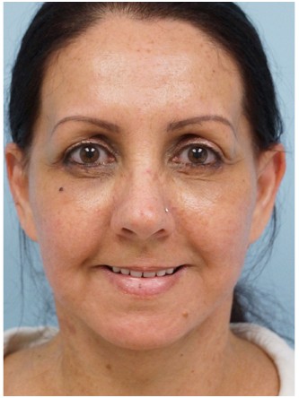 Aging Eyelid Rejuvenation, Facelift, Necklift 2* — After