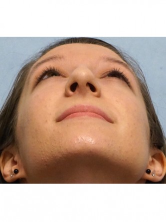Prominent Nose Closed Rhinoplasty* — Before