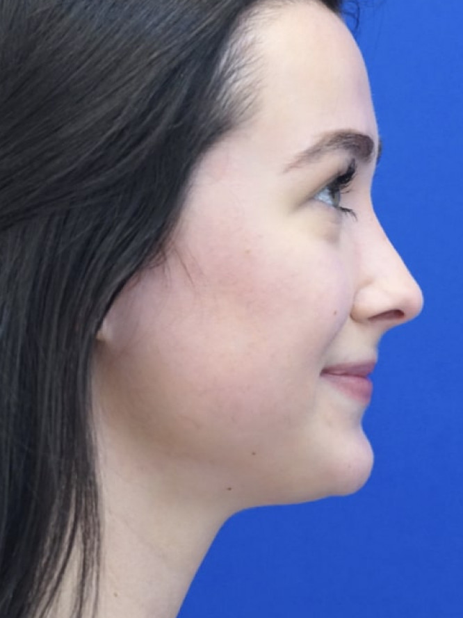 Soften Nasal Bridge — After