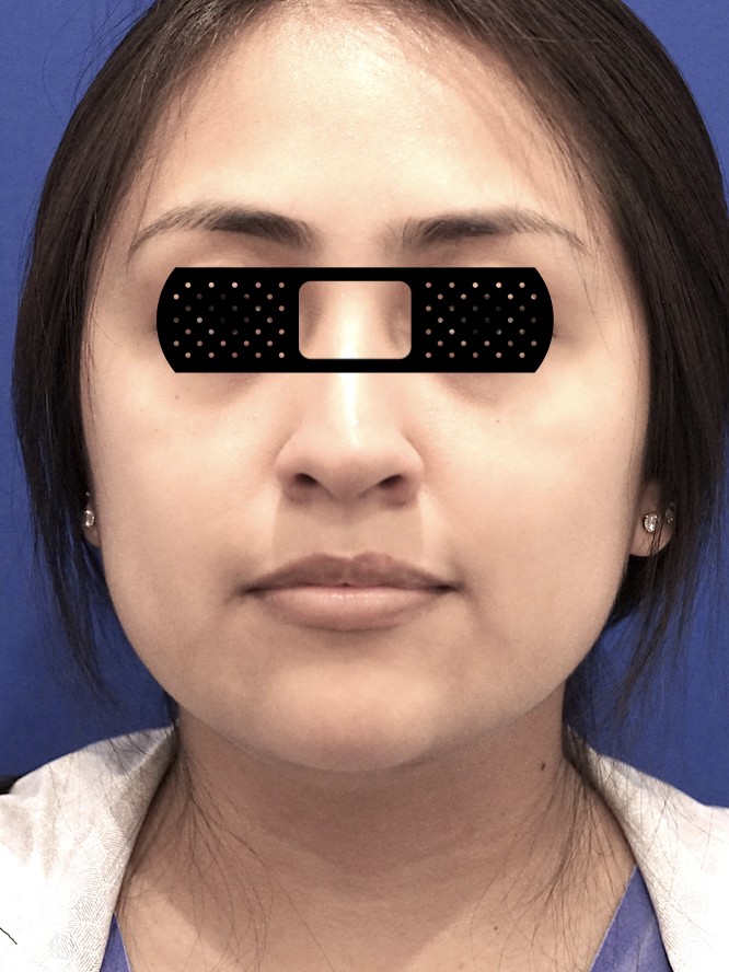 Buccal Fat Removal — Before