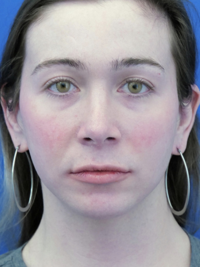 Soften Nasal Contour — After