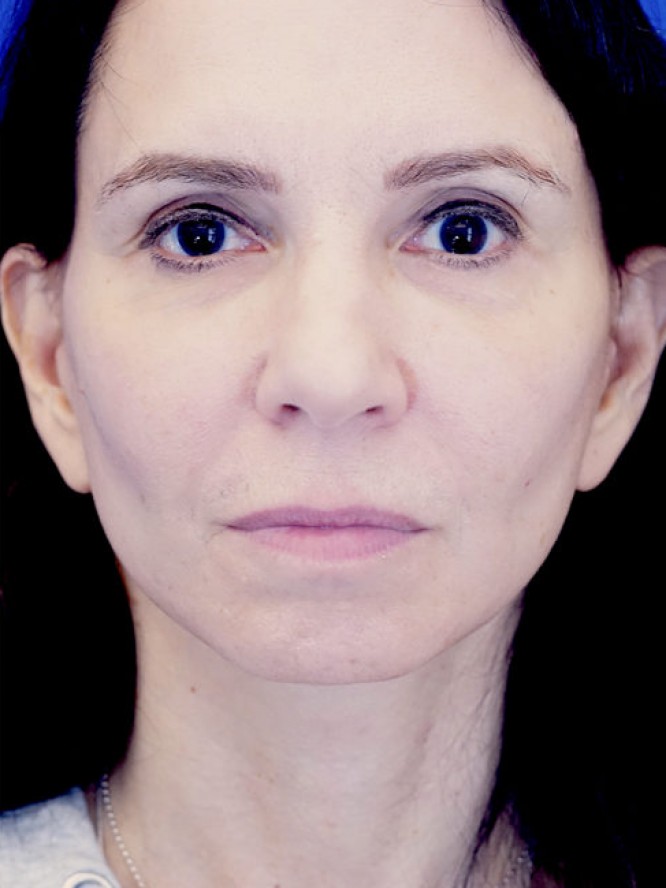 Deep Plane Jowl Lifting — After