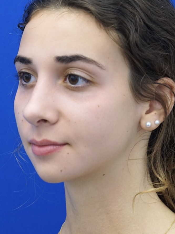 Classic Tension Nose — After
