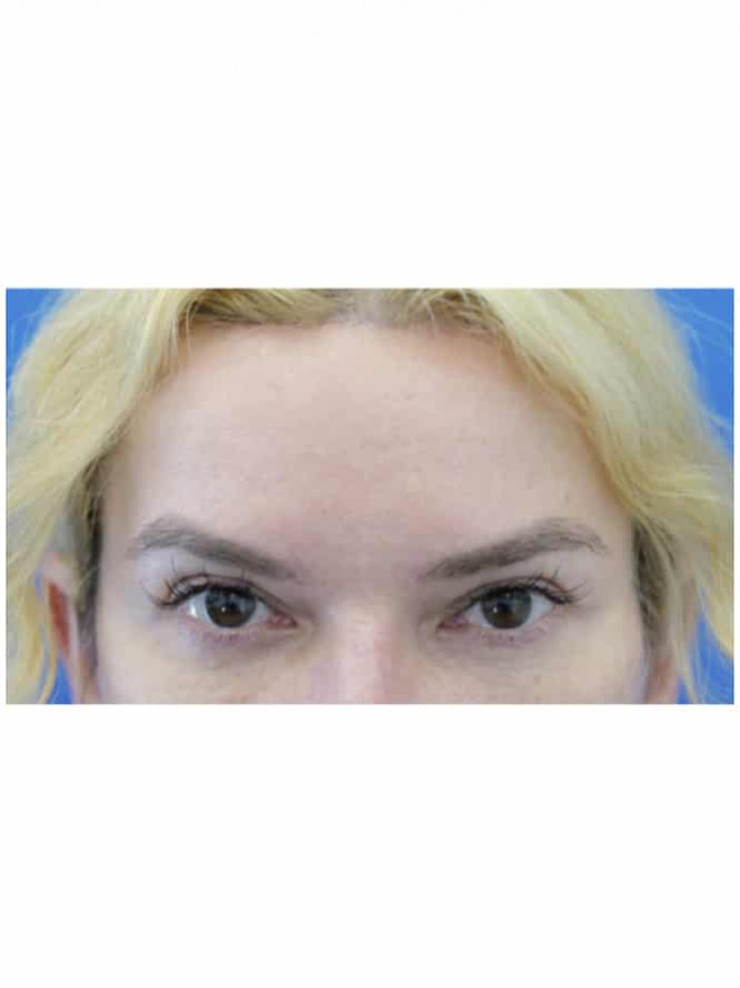 Cat Eye Blepharoplasty Browlift — After