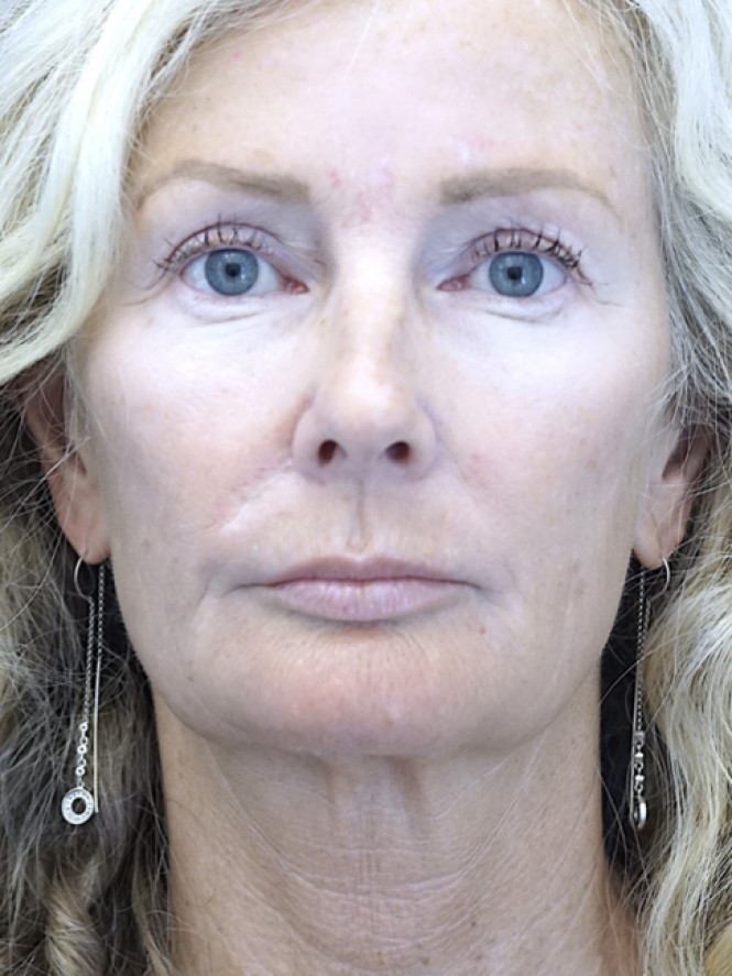 Scintillating Natural Result — Before