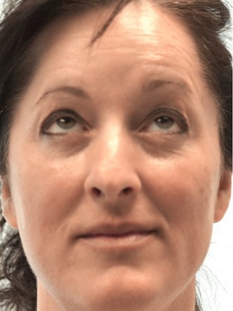 Botox Periorbital – Around the Eyes* — Before