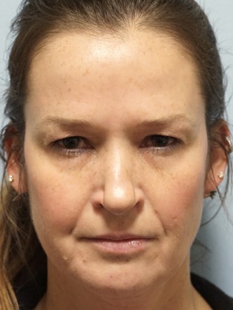 Excess Upper Eyelid Skin* — Before