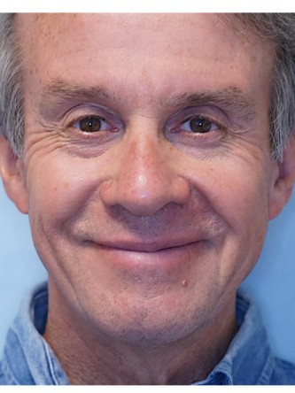 Droopy Eyelid Surgery* — After