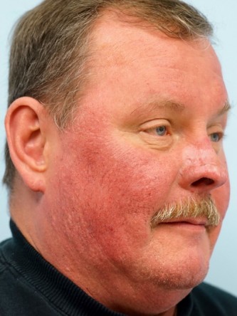 Rhinophyma* — After