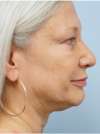 Over Projected Thick Skin Nose* — After