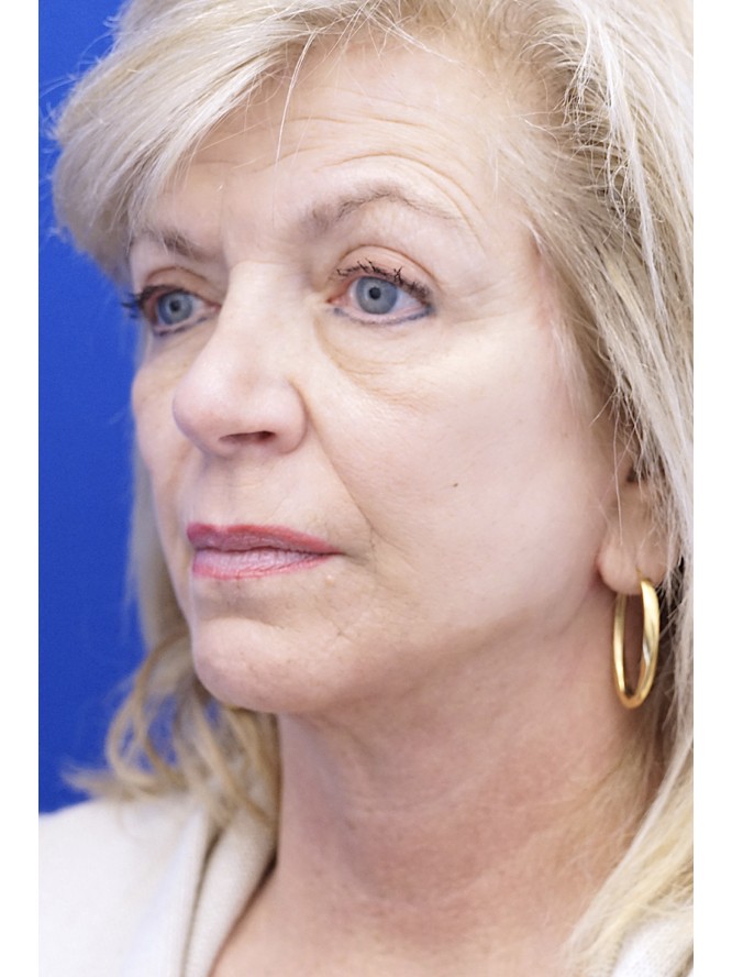 Jowls and Loose Neck Skin — After
